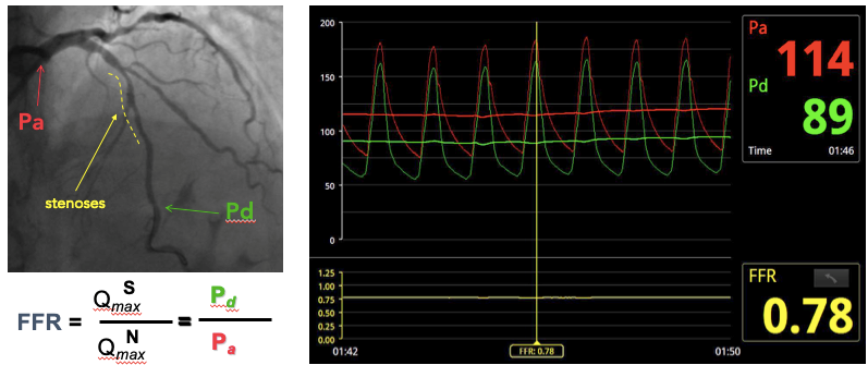 doenças cardiovasculares